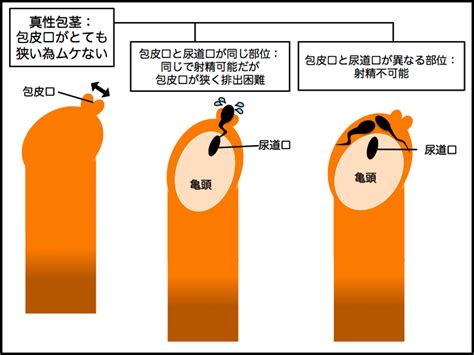 ちんこの皮|【図解】真性包茎・仮性包茎・カントン包茎。各種類。